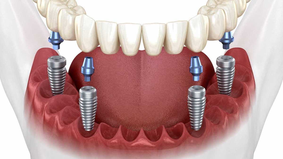 Implantes all on 4 en palma de mallorca