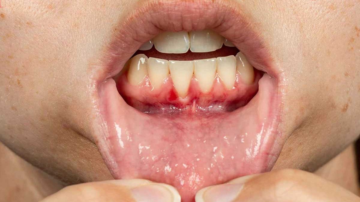 Tratamiento de la periodontitis en Mallorca